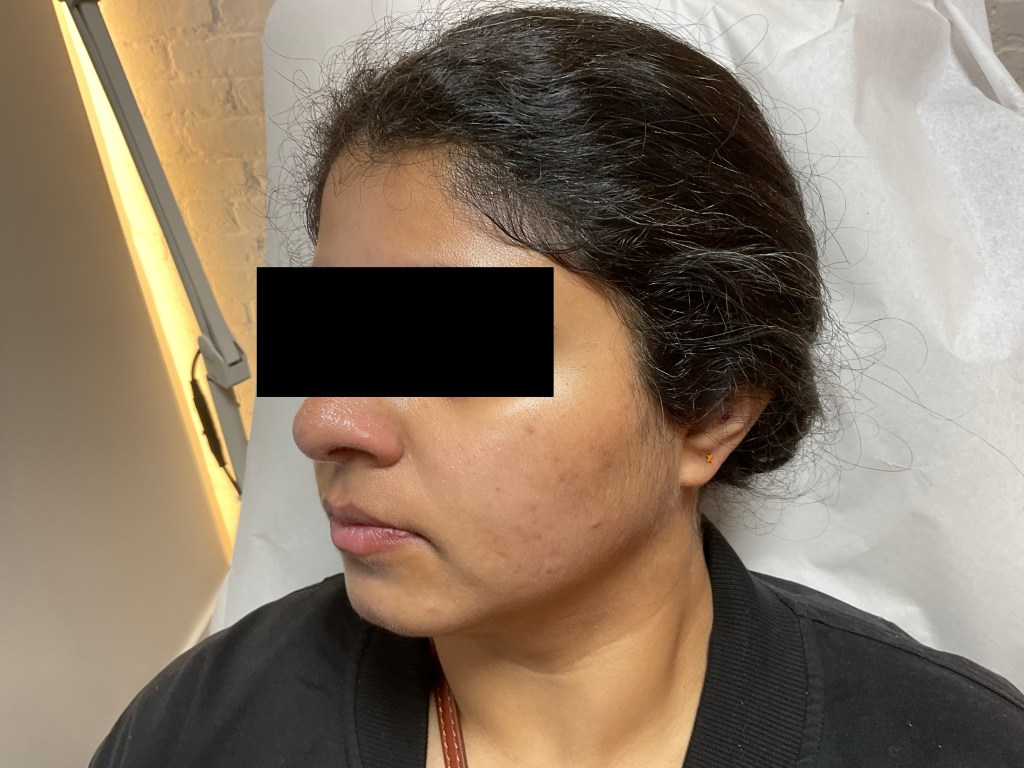 Chemical peel before and after photo