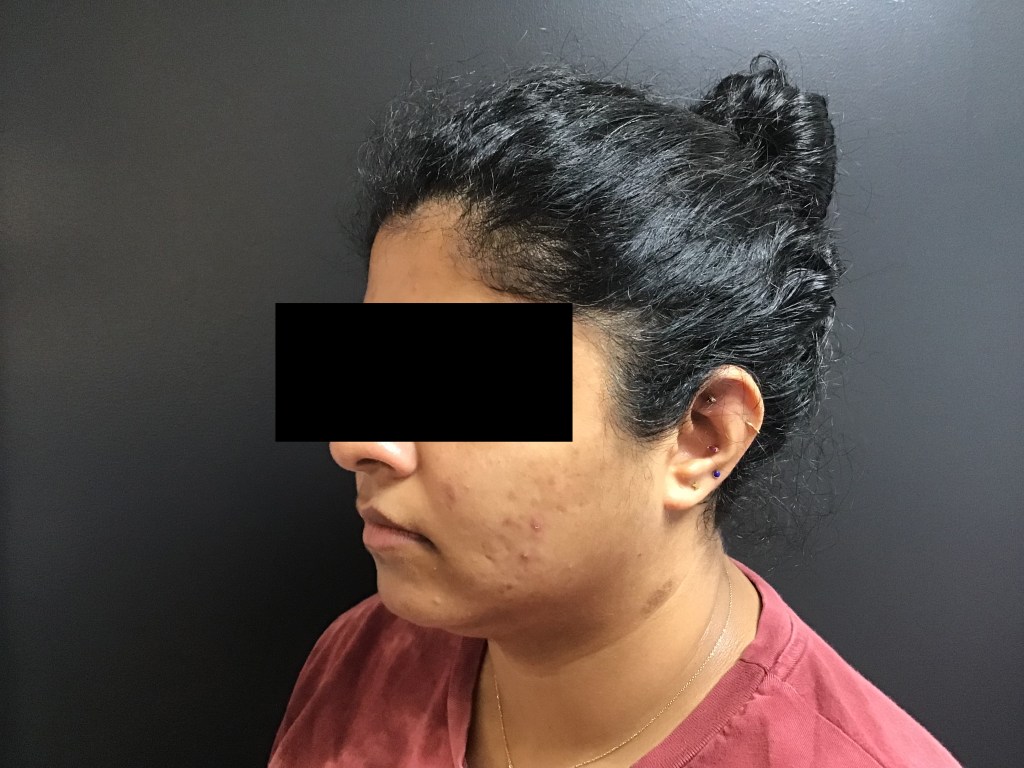 Chemical peel before and after photo