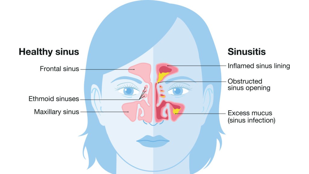 medical illustration of a healthy sinus and sinusitis