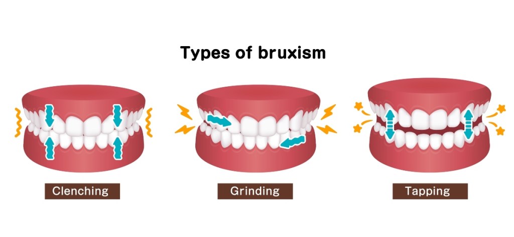 Types of bruxism