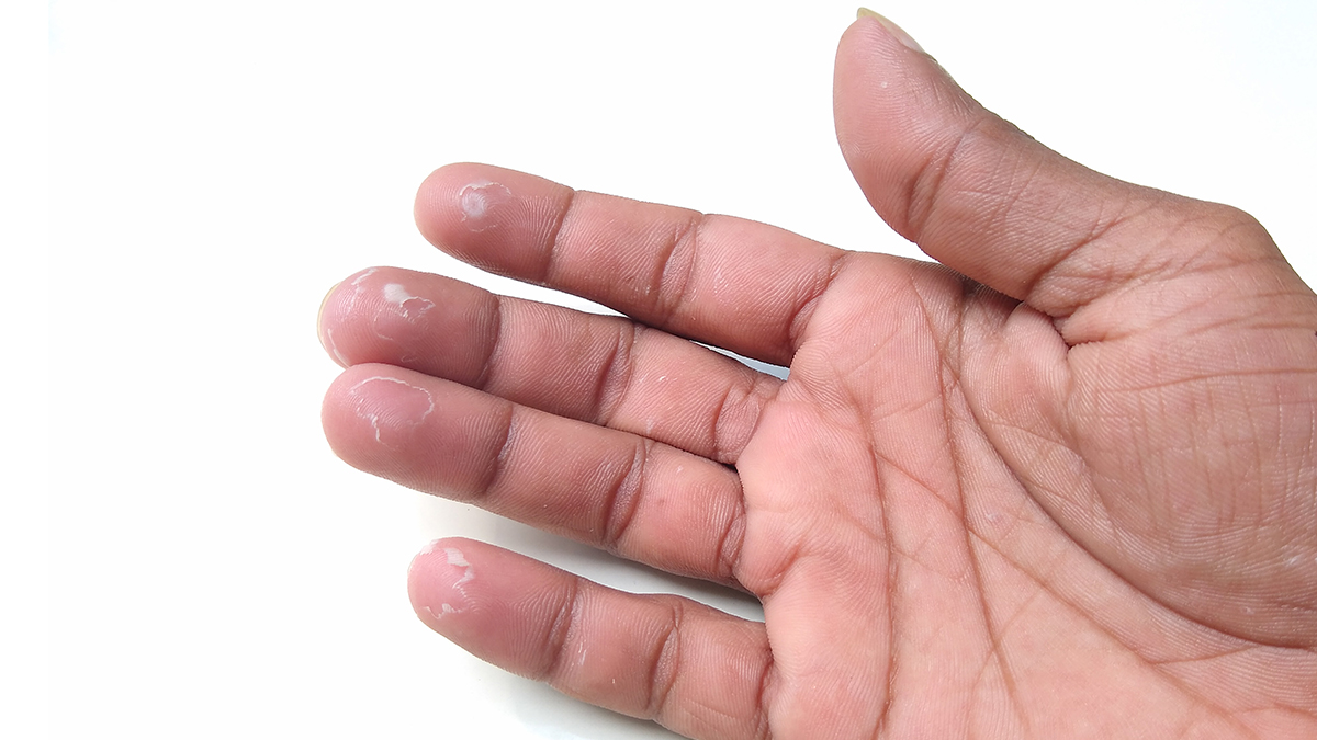 Damaged cuticle on the finger - cracks and dry skin - not groomed nails  Stock Photo | Adobe Stock