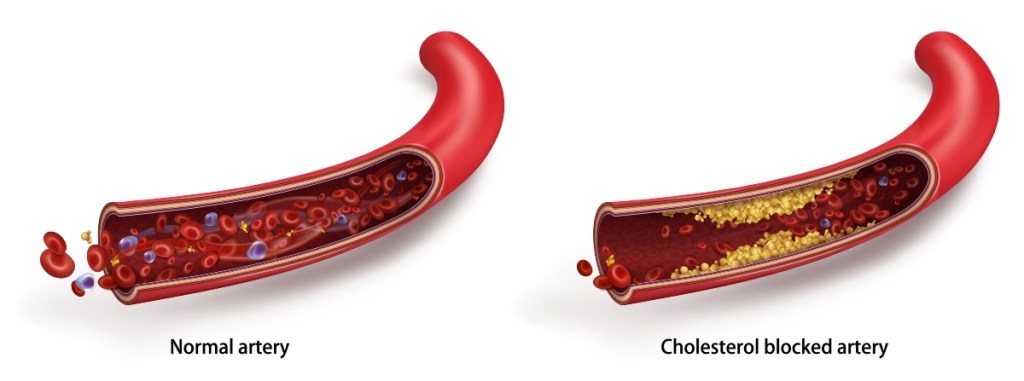 Red sage plant used to treat cholesterol-blocked arteries