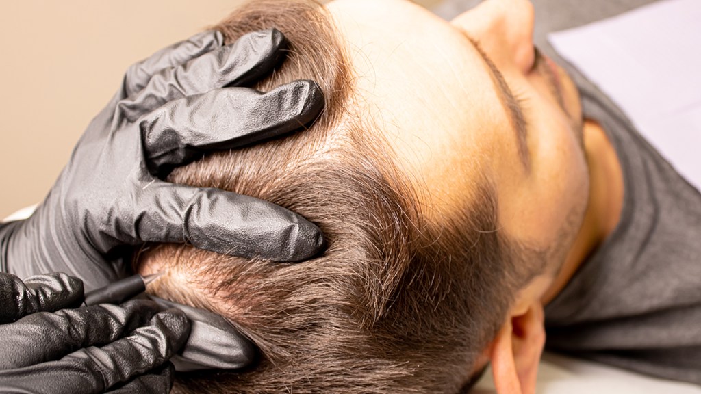 Scalp pigmentation procedure on a man's head