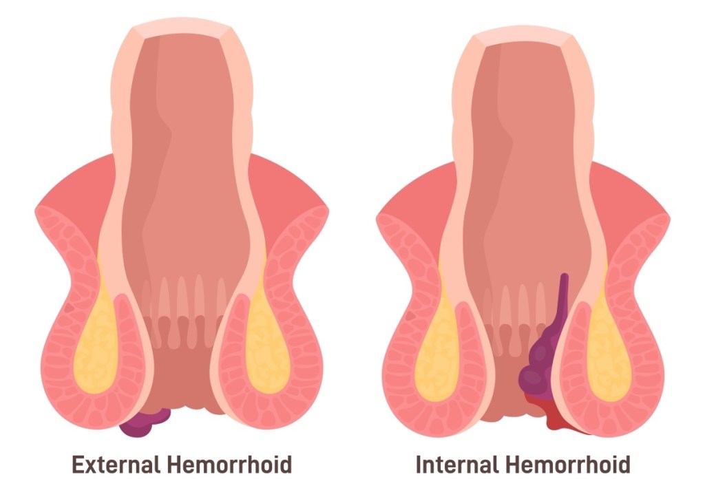 Internal and external hemorrhoids, which can be treated with witch hazel