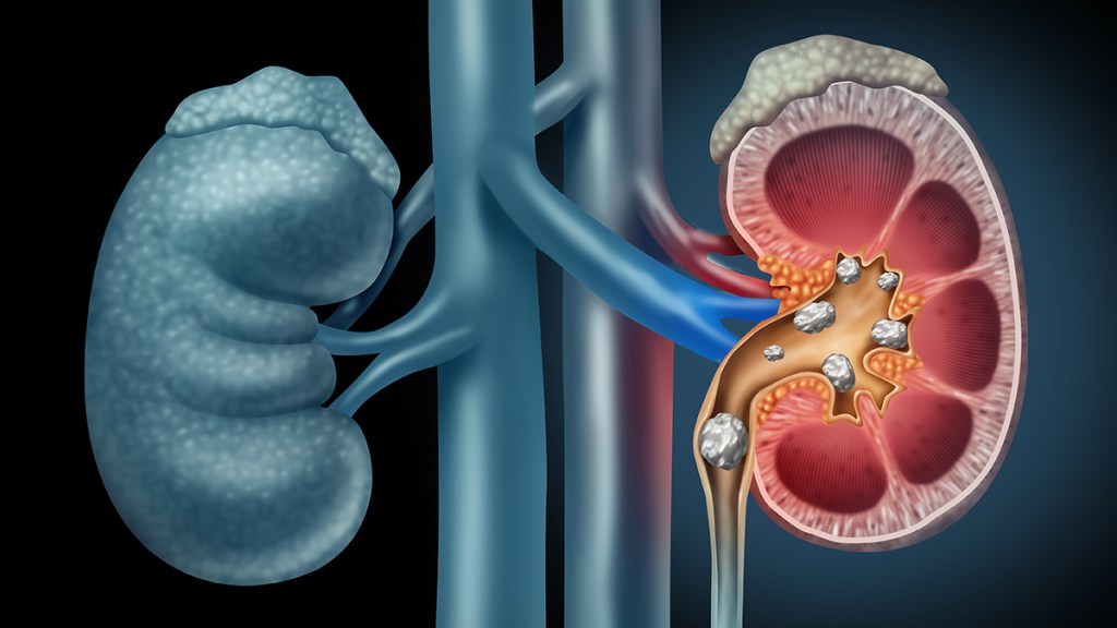 Medical illustration showing a kidney stone beginning to move down the ureter