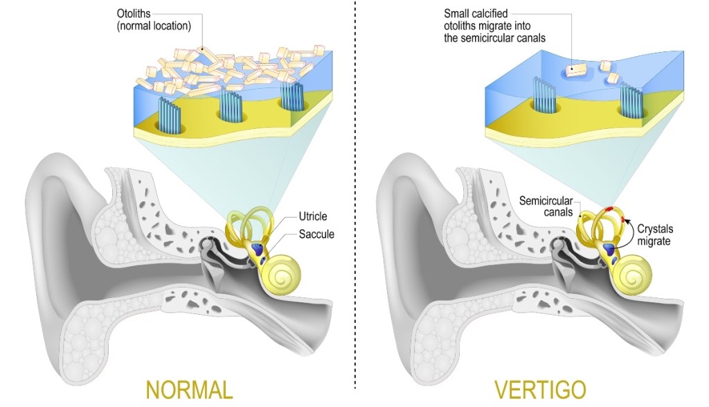 An illustration of the tiny "rocks" inside the ear that can cause vertigo
