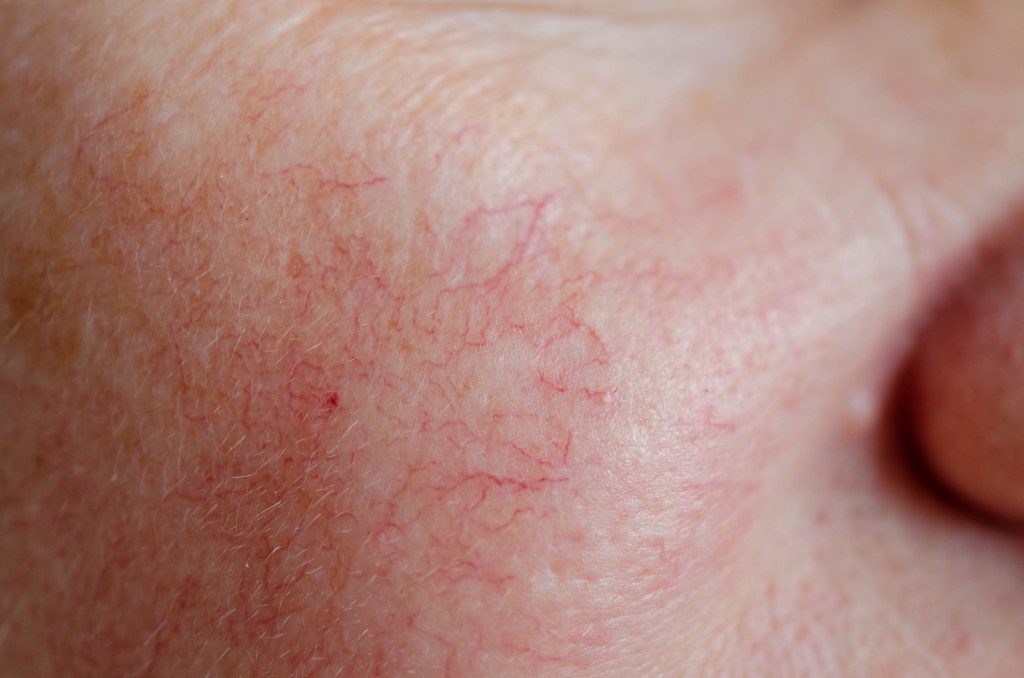 Close up of spider veins on face.