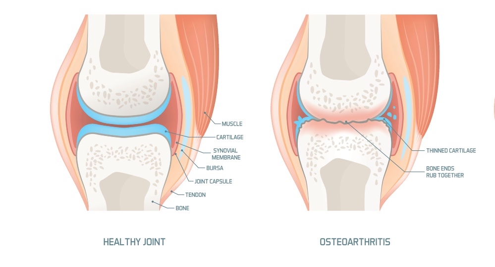 An illustration of osteoarthritis, which can benefit from marine collagen