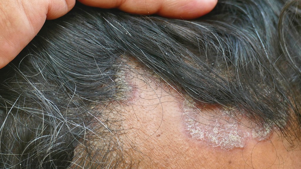 A man's hairline showing a kind of eczema that can be treated with tea tree oil