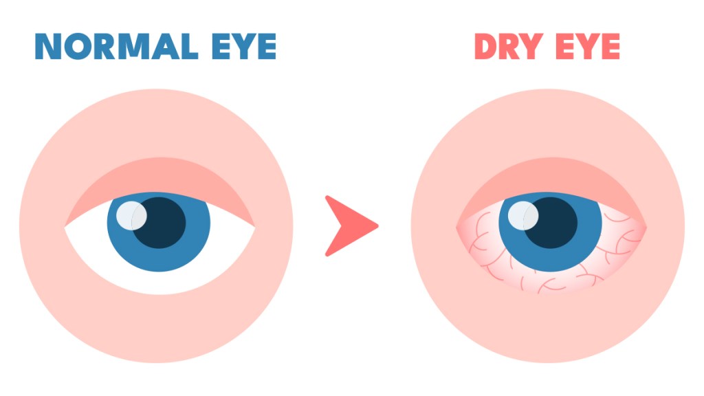 Illustration of a healthy eye and a dry eye