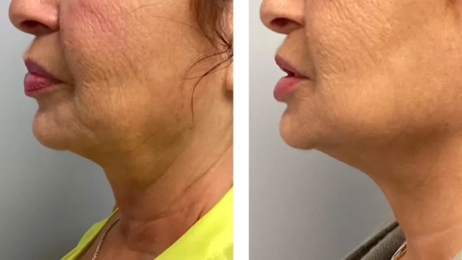 microneedling before and after for the neck