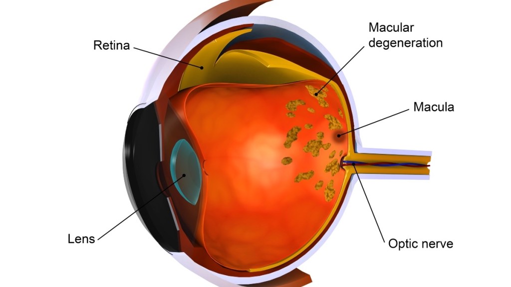 An illustration of age-related macular degeneration