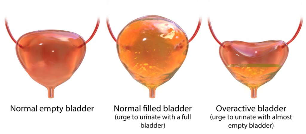 An illustrative of a normal bladder, a full bladder, and an overactive bladder which can cause bladder spasms