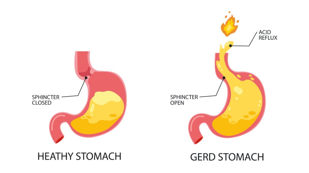 An illustration of GERD that can cause bad breath originating from the stomach