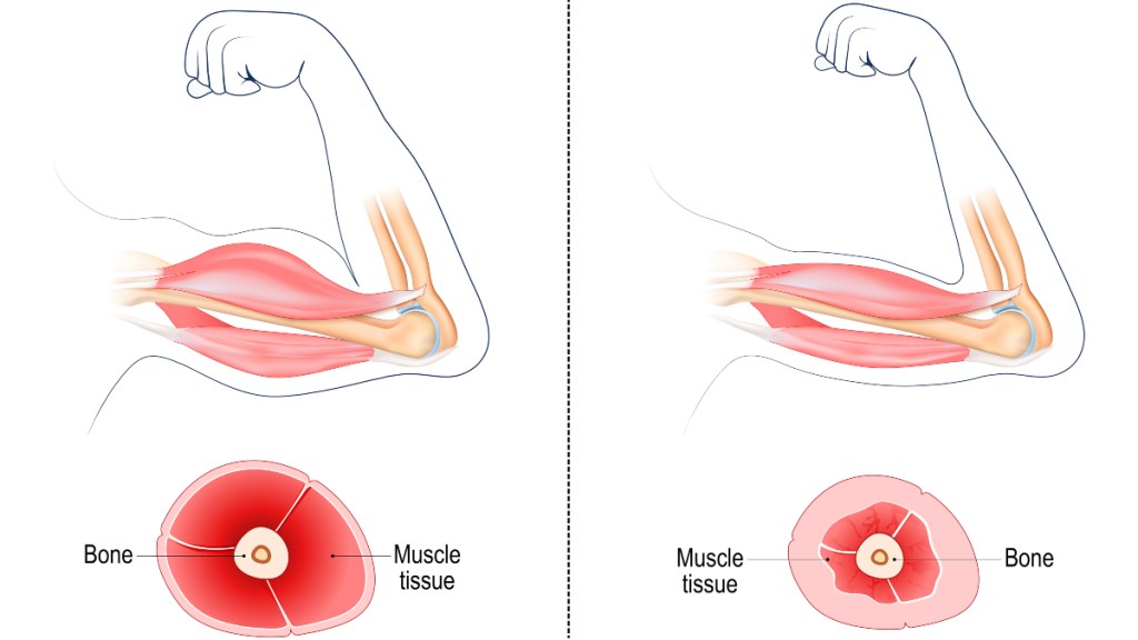 An illustration of sarcopenia, or age-related muscle loss