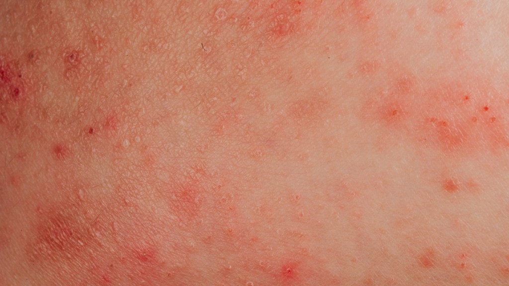 A close up of skin with breast eczema, which causes red bumps and irritation