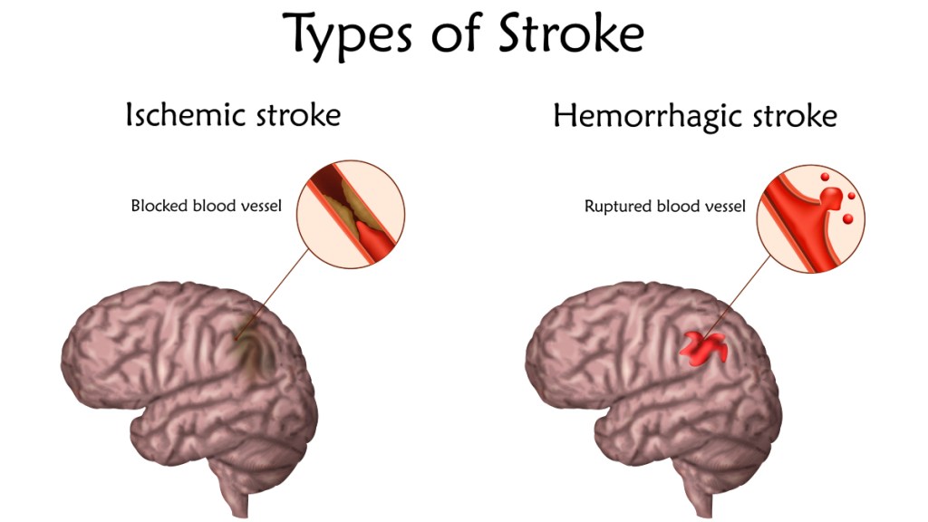 An illustration of an ischemic stroke and hemorrhagic stroke