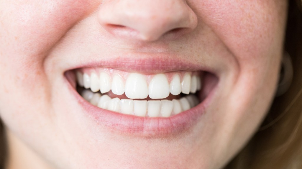 Close-up of a smiling woman with pale, white gums