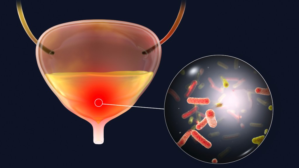 An illustration of a bladder with a urinary tract infection, which can cause mucus in urine