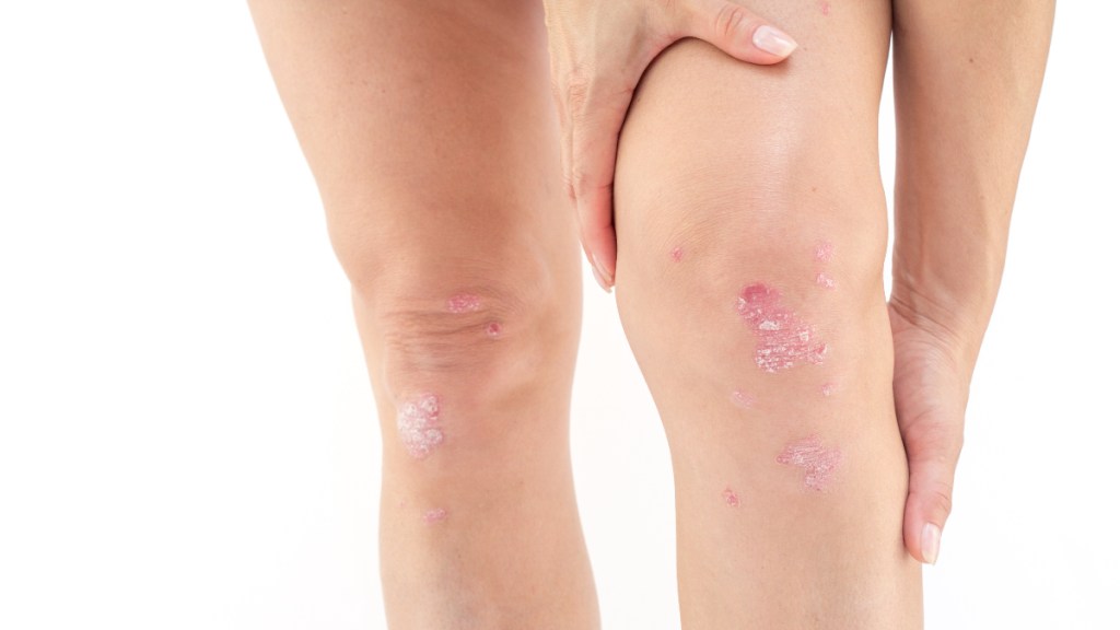 A close-up of a woman's knees with a rash, which is an early warning sign of psoriatic arthritis