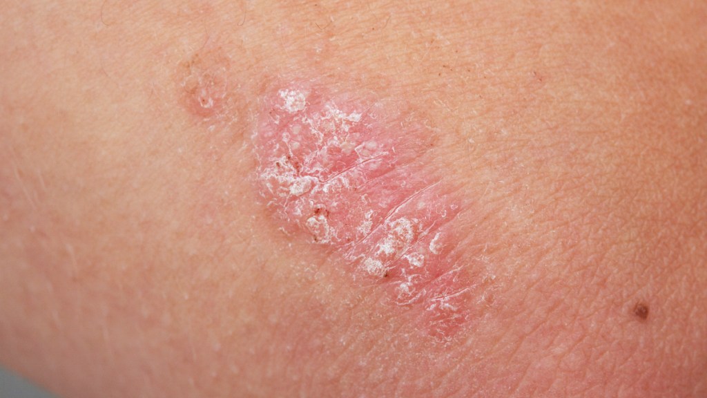 Psoriasis plaque or skin rash