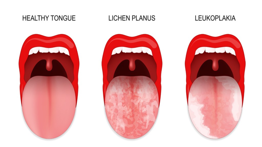 An illustration of oral lichen planus and leukoplakia, two causes of white gums