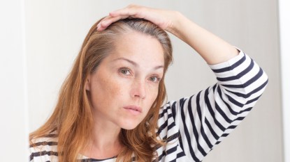 A woman in a striped shirt with her hand on her head examining hair loss caused by Ozempic