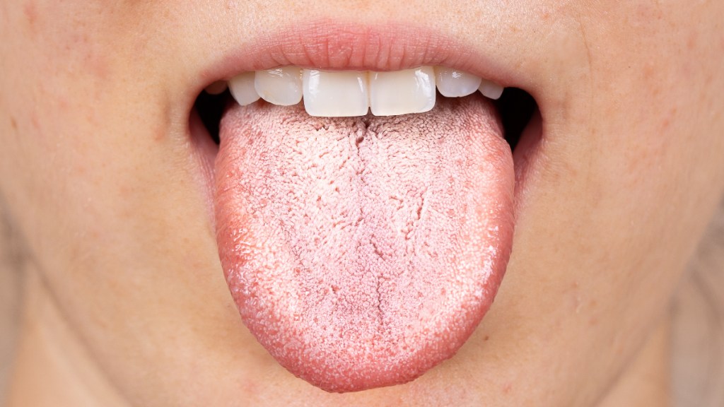 A woman sticking out her tongue, which is white due to oral thrush