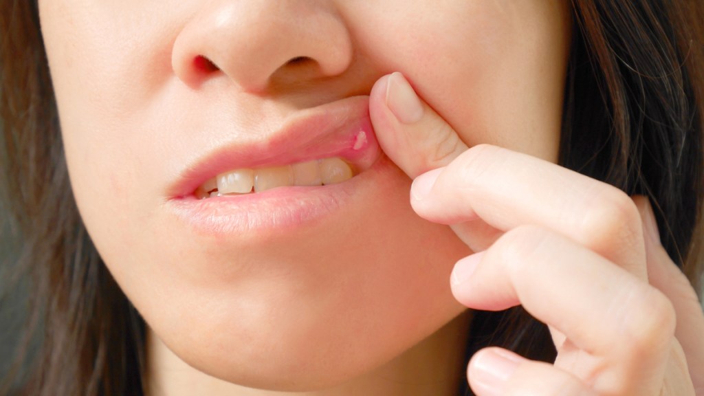 A close-up of a woman holding her lip up to reveal a canker sore