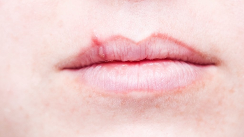 A close-up of a woman's lips with a cold sore